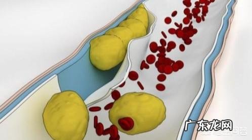 减肥反而低密度脂蛋白升高 减肥低密度脂蛋白高怎么办？