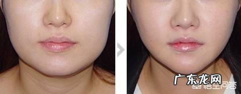 面部吸脂多久能有明显的效果?