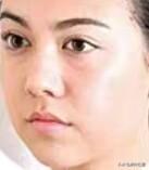 长期使用瘦脸仪会有效果吗？