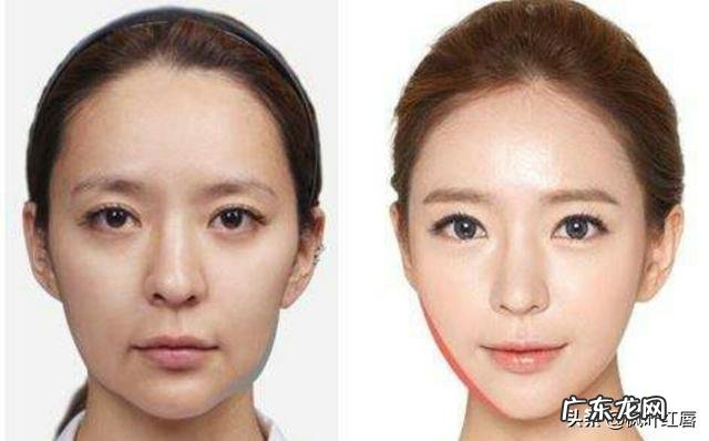 长期使用瘦脸仪会有效果吗？