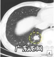 消除身体结节最好方法是什么?