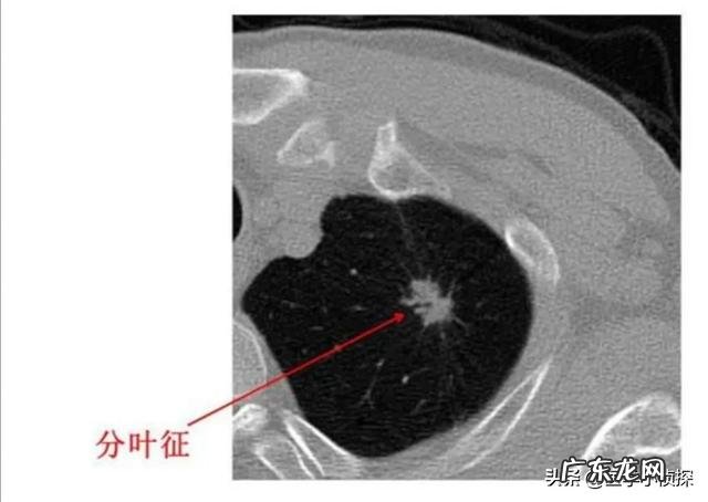 消除身体结节最好方法是什么?