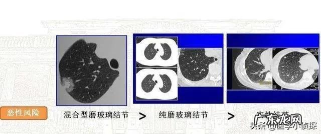 消除身体结节最好方法是什么?