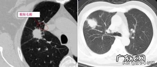 消除身体结节最好方法是什么?