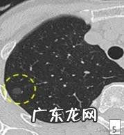 消除身体结节最好方法是什么?