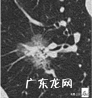 消除身体结节最好方法是什么?