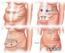 产后肚子大涨怎么办 产后肚子大且下垂怎么办？