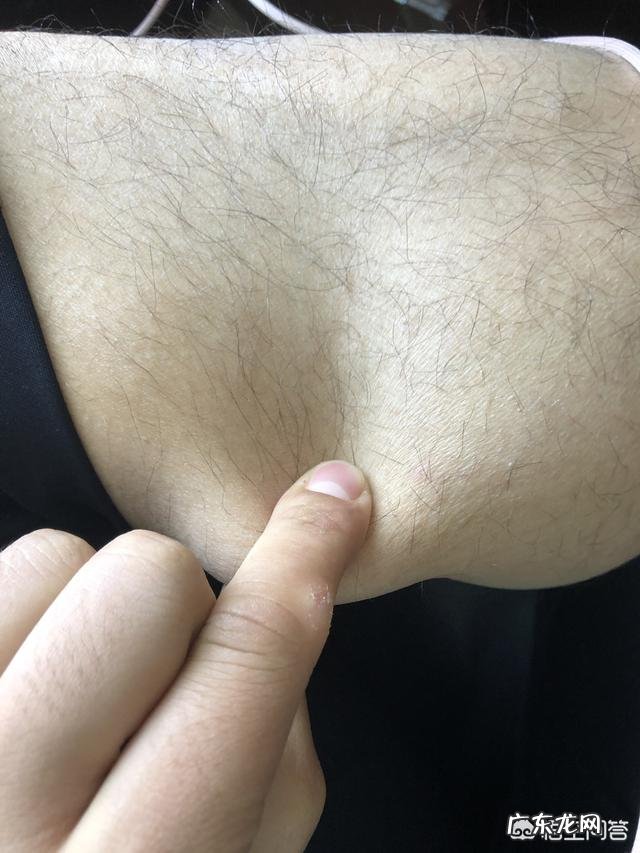 乳腺增生和结节,可以每天热敷缓解吗?