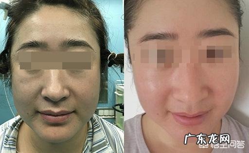 脸上长痘痘适合吃什么食物?