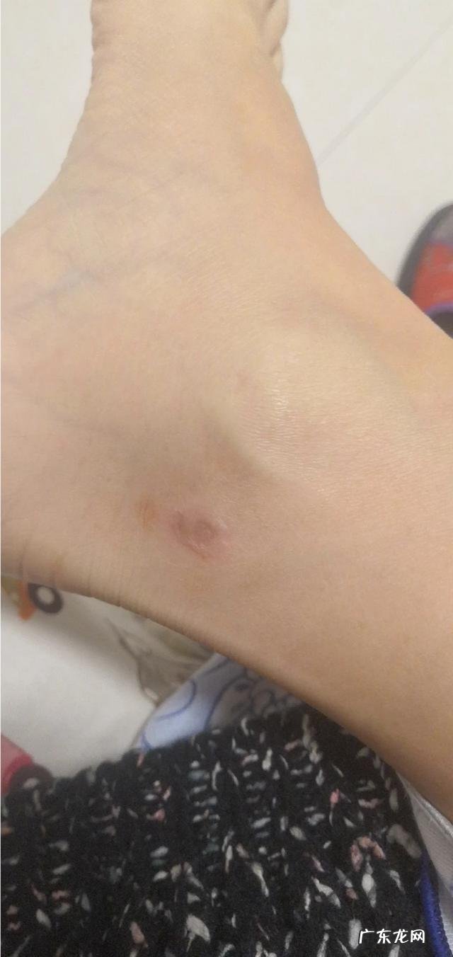 艾灸排寒湿是这样的吗?怎么感觉像烫伤?