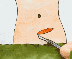 剖腹产后使用“镇痛泵”对身体有副作用吗?