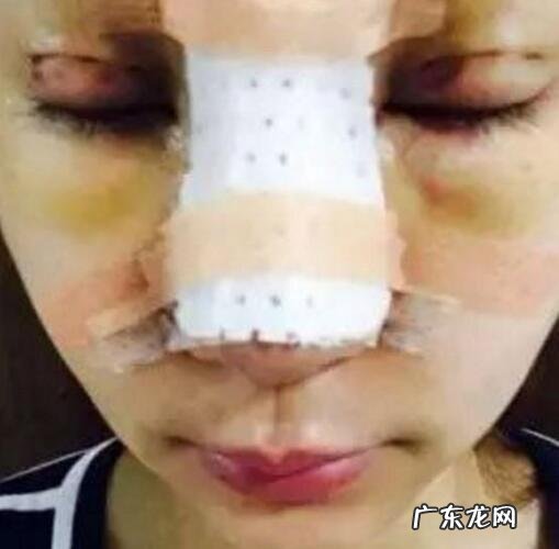 又有一女孩花百万整成迪丽热巴，大家怎么看待整容？