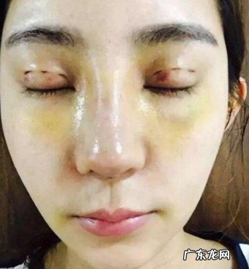 又有一女孩花百万整成迪丽热巴，大家怎么看待整容？