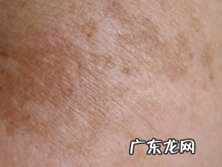 有什么好的办法可以清除脸上的黄褐斑？