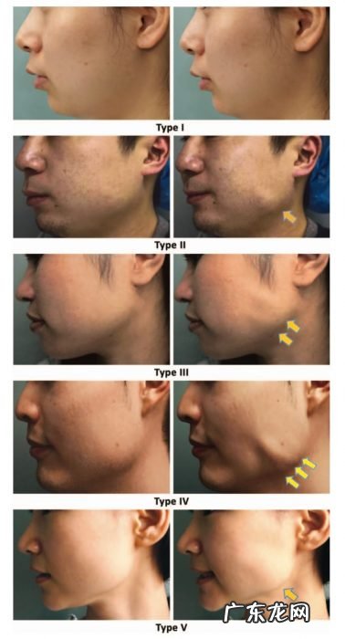 很遗憾，脸变大变方是停不下来的