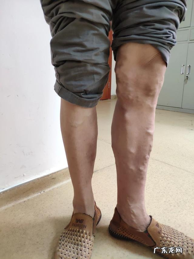 普通丝袜能当静脉曲张袜穿吗?