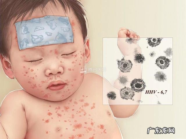 宝宝晚上发热怎么处理幼儿急疹-宝宝得了幼儿急疹3天后又发热了