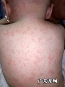 宝宝晚上发热怎么处理幼儿急疹-宝宝得了幼儿急疹3天后又发热了