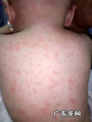 宝宝晚上发热怎么处理幼儿急疹-宝宝得了幼儿急疹3天后又发热了