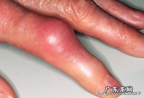 运动会降低血压和血脂吗?