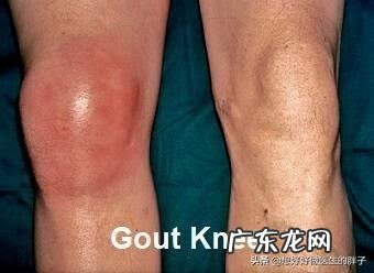 运动会降低血压和血脂吗?