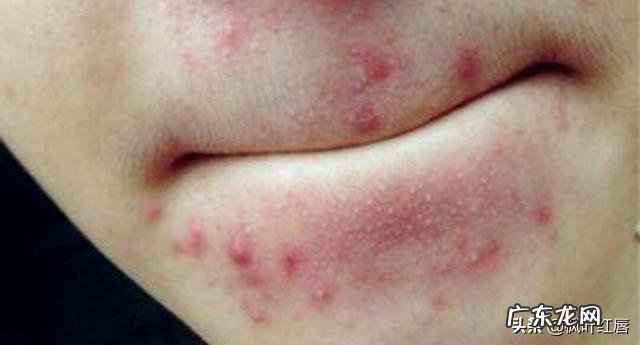 脸上疯狂长痘，是不是螨虫已经成堆了？怎么才能祛痘啊？