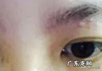 脸上疯狂长痘，是不是螨虫已经成堆了？怎么才能祛痘啊？