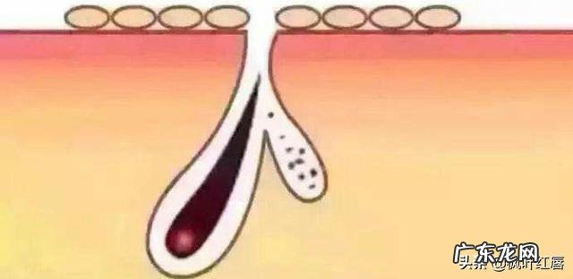 脸上疯狂长痘，是不是螨虫已经成堆了？怎么才能祛痘啊？