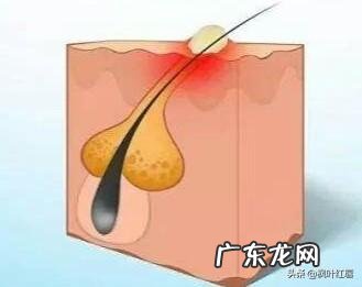 脸上疯狂长痘，是不是螨虫已经成堆了？怎么才能祛痘啊？