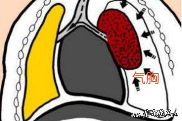 本人男,左胸有点轻微的隐痛咋回事?有时痛有时不痛?