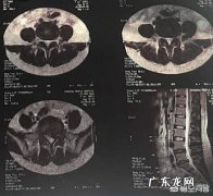 推拿zhi疗腰椎间盘突出图解 腰椎间盘突出是否试过推拿？推拿后症状是否明显缓解？