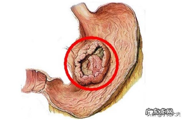 胃癌晚期会出现哪些征兆呢？