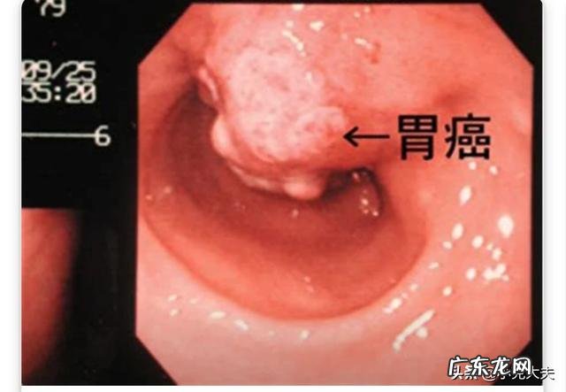 胃癌晚期会出现哪些征兆呢？