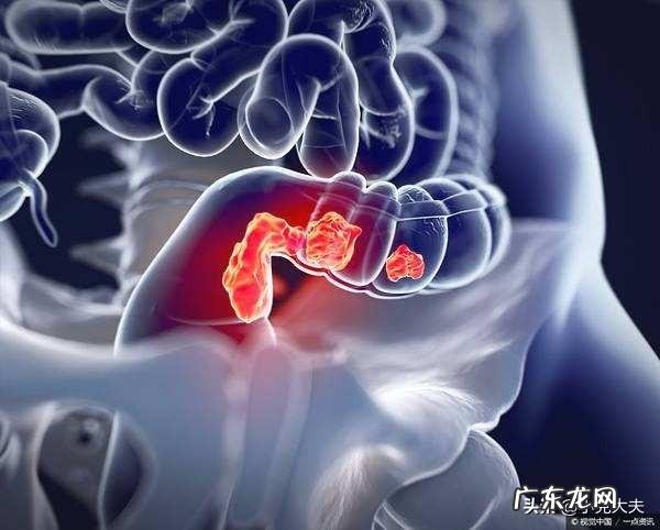 肠癌被发现就是晚期吗？有哪些症状显示？