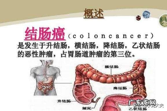 肠癌被发现就是晚期吗？有哪些症状显示？