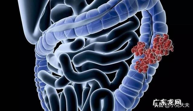 肠癌被发现就是晚期吗？有哪些症状显示？