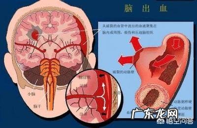 脑溢血的zhi疗方法和注意事项 脑溢血如何zhi疗?在恢复时需要注意什么?