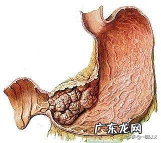 胃癌的患者是不是很消瘦呢?
