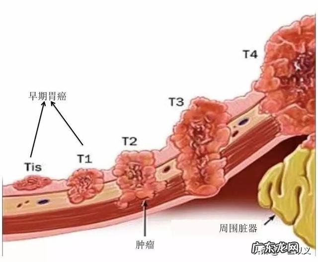 胃癌的患者是不是很消瘦呢?