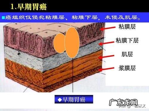 胃癌的患者是不是很消瘦呢?