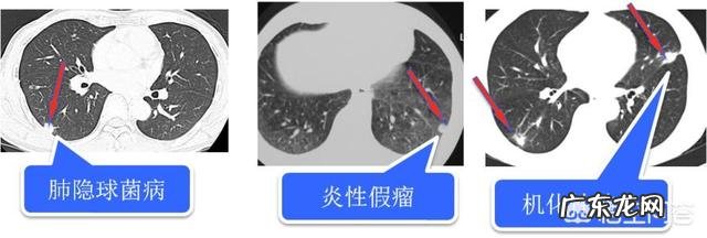 活动量大了后背肌肉疼,肋骨疼是怎么回事?跪求解答谢谢?