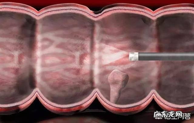 看新闻又一个年轻人因肠癌离世，肠癌怎么这么可怕，可以预防吗？