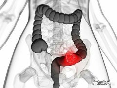 腹泻两年了，是早期结直肠癌吗？早期结肠癌有哪些症状？