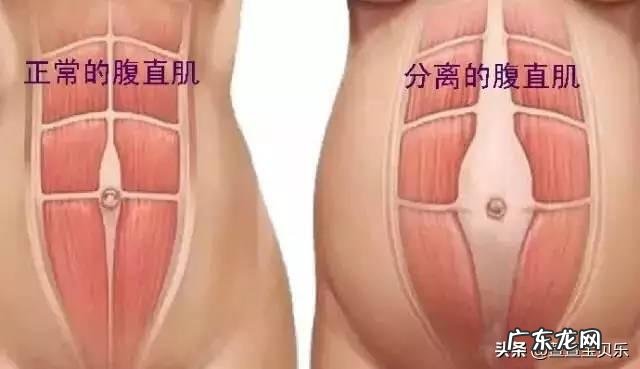 产后腹直肌分离怎么通过运动来恢复?