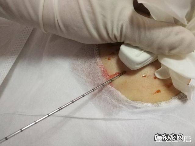 乳腺结节3ji中药调理有效果吗 乳腺纤维瘤喝中药会好吗？