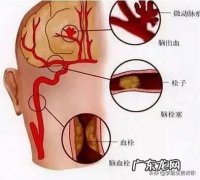哪些生活习惯会爆发脑梗？