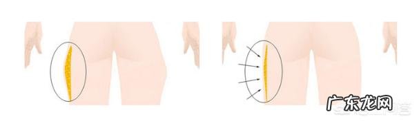 大腿吸脂不会影响到内分泌吧?