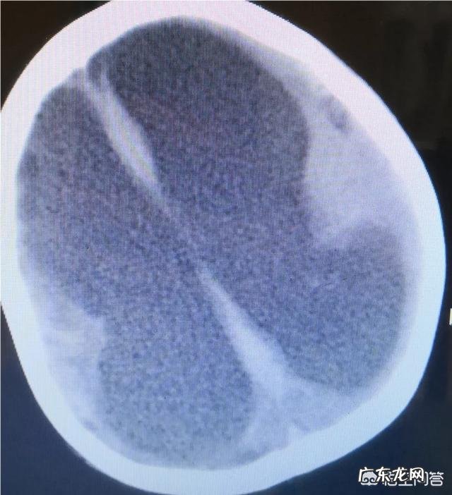 脑出血导致一侧偏瘫,能康复吗?