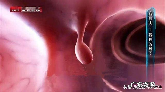 做肠镜发现有点结肠息肉咋办 如果每年都做肠镜,发现息肉就处理,是不是得结肠癌的可能不大?