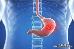 女子身体出现“1臭3多”，确诊胃癌晚期，具体是什么症状？